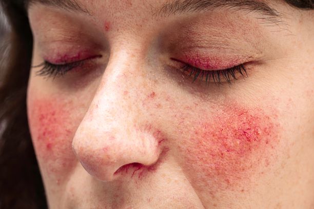 Realities of Rosacea
