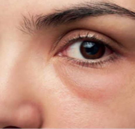 Eye Conditions Exposed Signature Class