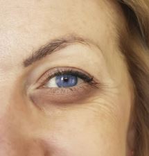 aesthetic eye treatments class