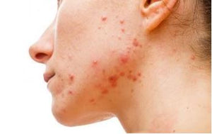 Acne Exposed Signature Class