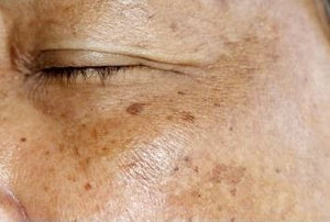 Hyperpigmentation Exposed Signature Class