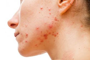 acne aesthetic courses online