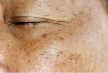 Load image into Gallery viewer, hyperpigmentation esthetic class online
